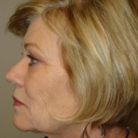 Before image 4 Case #79061 - Upper and lower Eyelid Surgery
