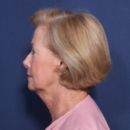 Before image 2 Case #83846 - 69 Year Old Female