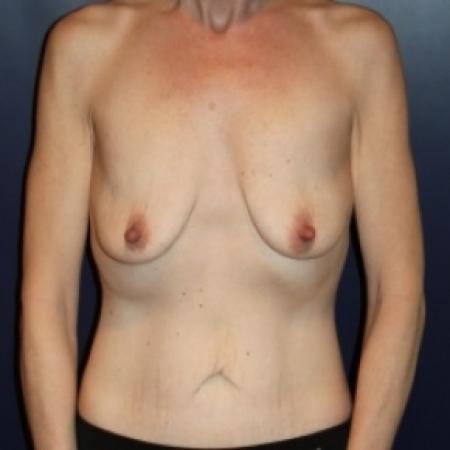 Before image 1 Case #80391 - Natural Proportional Breast Augmentation