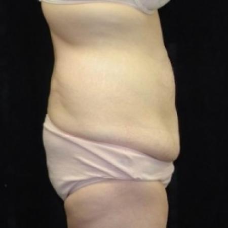Before image 2 Case #80226 - Circumfrential Abdominoplasty with Liposuction of Abdomen, Waist, and Flanks