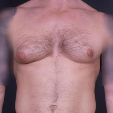 Before image 1 Case #85091 - Bilateral Liposuction with Excision for Gynecomastia