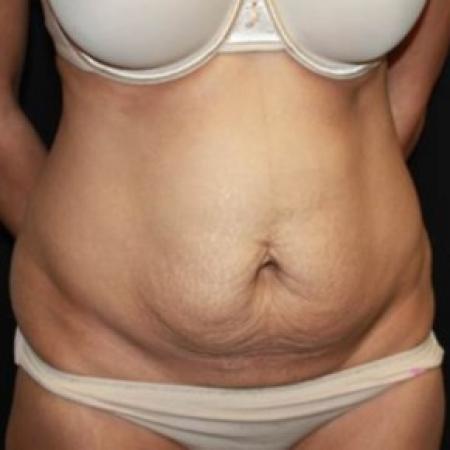 Before image 2 Case #85591 - Abdominoplasty - 44 year old female