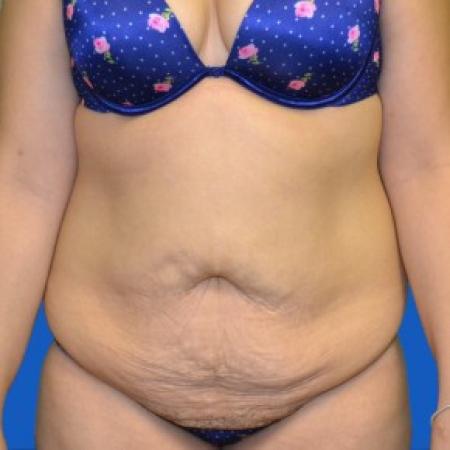 Before image 1 Case #87851 - Tummy Tuck