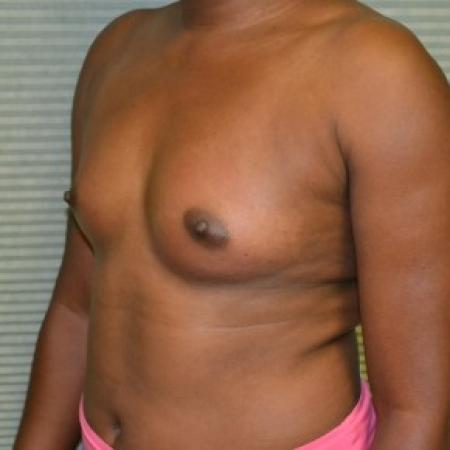 Before image 2 Case #87811 - Breast Augmentation with Mentor MemoryGel smooth round 375cc high profile silicone gel filled breast implants.