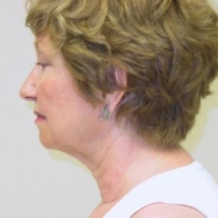 Before image 3 Case #81041 - Facelift