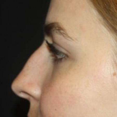 Before image 3 Case #85266 - Rhinoplasty - 20 year old female