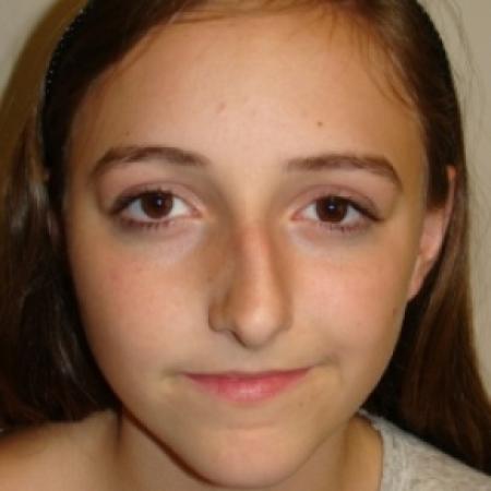 Before image 1 Case #80406 - Open Rhinoplasty