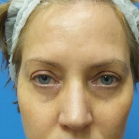 Before image 1 Case #87406 - 54 year old  -  Upper Blepharoplasty/Lower Eyelid Fat Grafting & TCA Peel.  3 months Post-op