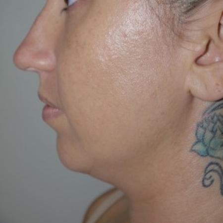 Before image 1 Case #82556 - Liposuction of the chin and neck