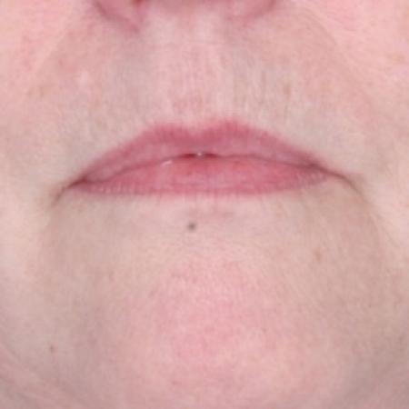 Before image 1 Case #79286 - Injectables