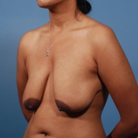 Before image 2 Case #79981 - Breast Lift