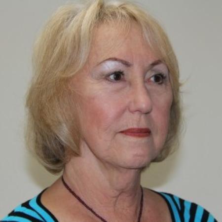 Before image 2 Case #84626 - Lower facelift, necklift and browlift with SMAS grafting to Nasolabial folds