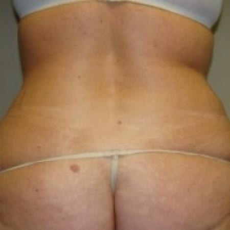 Before image 4 Case #79471 - Tummy Tuck