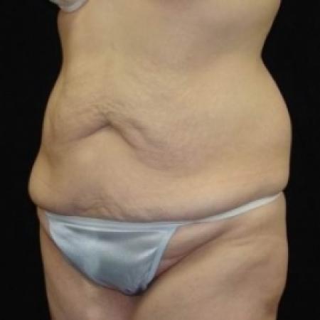 Before image 4 Case #80226 - Circumfrential Abdominoplasty with Liposuction of Abdomen, Waist, and Flanks