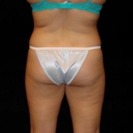 Before image 5 Case #80331 - Buttocks Augmentation Via Fat Grafting with Liposuction of Abdomen, Waist, Flanks, Dorsal Roll, Inner and Outer Thighs