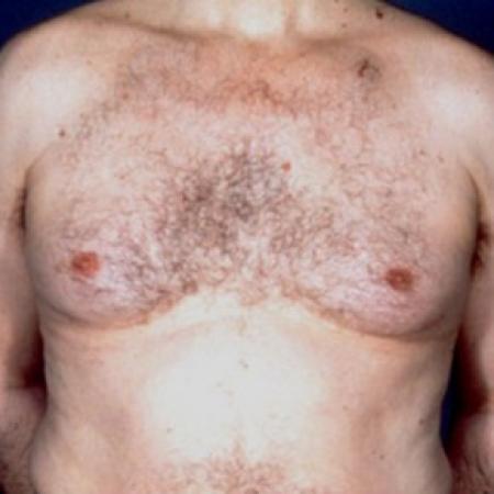 Before image 1 Case #81516 - Gynecomastia