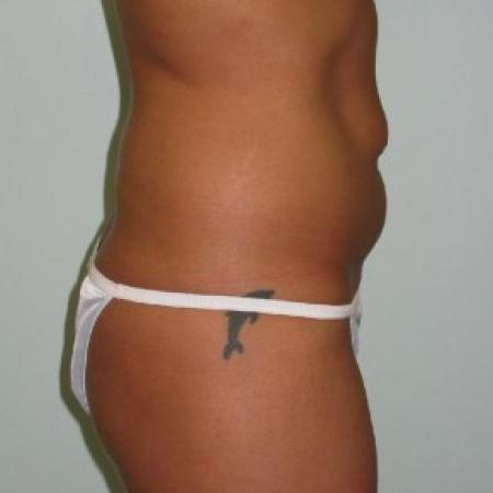 Before image 2 Case #82606 - Tummy Tuck after Weight Loss