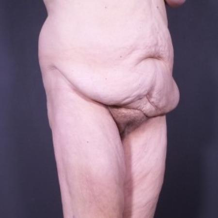 Before image 2 Case #85281 - Fleur De Lis Abdominoplasty after Weight Loss