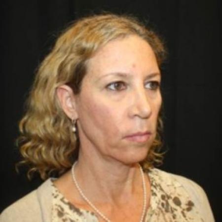 Before image 2 Case #85271 - Facelift and Neck Lift - 49 year old female