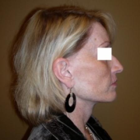 Before image 3 Case #79801 - Sculptra