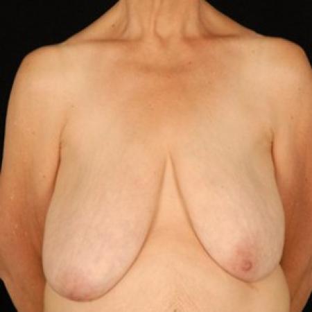Before image 1 Case #81456 - Breast Reduction/Lift