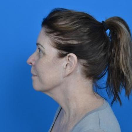 Before image 3 Case #87926 - Facelift and Necklift