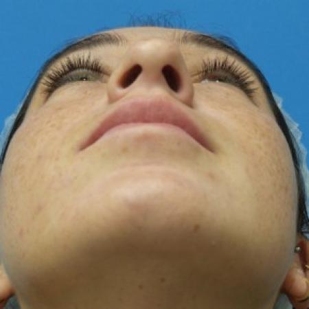 Before image 4 Case #87441 - 21 year old  -  Rhinoplasty  -  6 months post-op