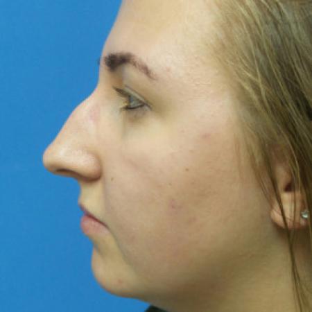 Before image 3 Case #88316 - 19 year old  -  Open Rhinoplasty  -  6 months post-op