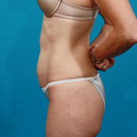 Before image 3 Case #80516 - Tummy Tuck
