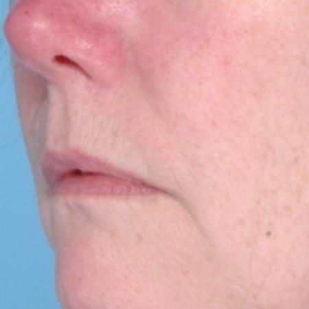Before image 3 Case #79286 - Injectables