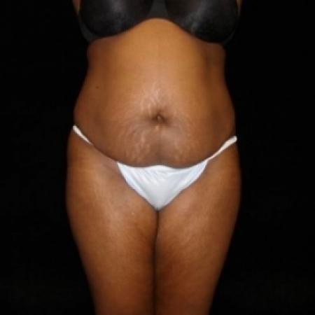 Before image 1 Case #80486 - Buttocks Augmentation Via Fat Grafting with Liposuction of Abdomen, Waist, Flanks, and Dorsal Roll