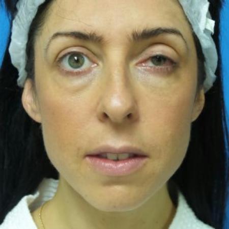 Before image 1 Case #86856 - 40 year old woman treated with Nose Surgery/Septoplasty/Turbinectomy