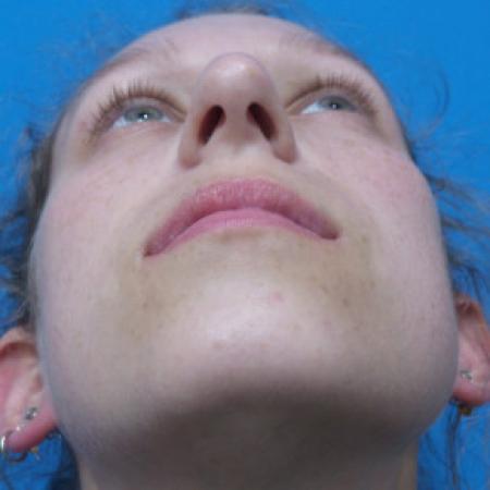 Before image 4 Case #88391 - 25 year old  -  Rhinoplasty/Septoplasty/Partial Turbinectomy  -  7 months post-op