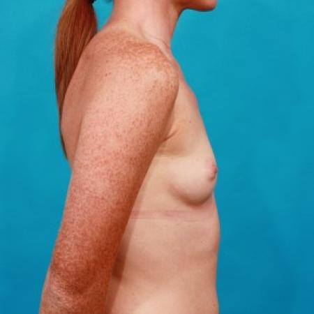 Before image 3 Case #84041 - Silicone Breast Augmentation