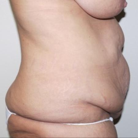 Before image 2 Case #82806 - Abdominoplasty