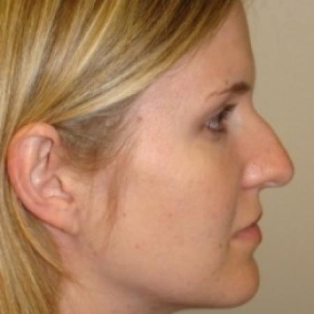 Before image 4 Case #79551 - Rhinoplasty