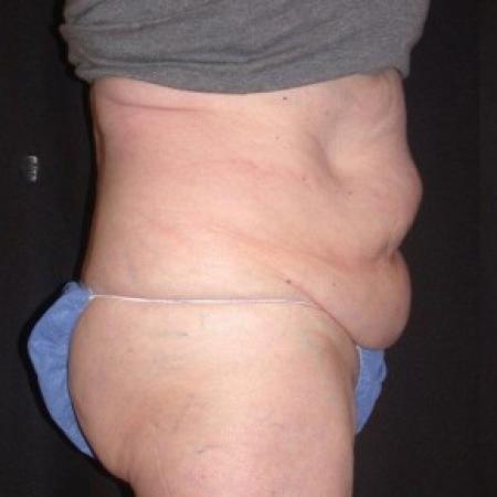 Before image 3 Case #81861 - CoolSculpting