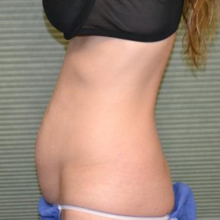 Before image 3 Case #87861 - Tummy Tuck