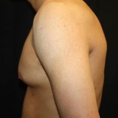 Before image 3 Case #85276 - Gynecomastia - 17 year old male 