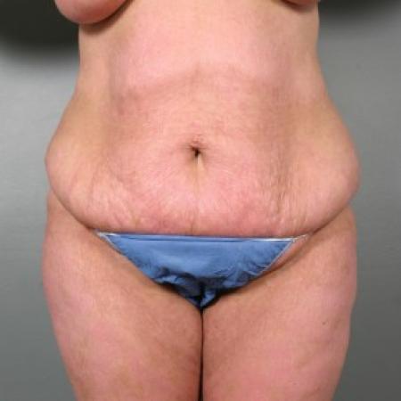 Before image 1 Case #83346 - Abdominoplasty
