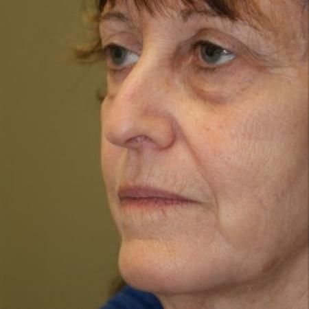 Before image 2 Case #81916 - Facelift