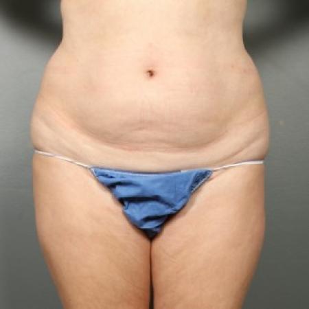 Before image 1 Case #83611 - Liposuction Hips