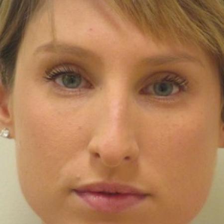 Before image 1 Case #82791 - Septorhinoplasty