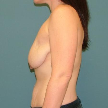 Before image 3 Case #86741 - Mastopexy+ Breast Augmentation