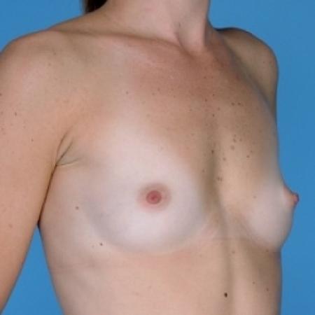 Before image 2 Case #79121 - Silicone 