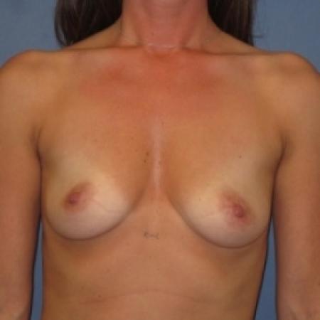 Before image 1 Case #80706 - Breast Augmentation
