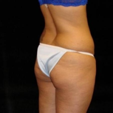 Before image 2 Case #80456 - Buttocks Augmentation Via Fat Grafting with Liposuction of Abdomen, Waist, Flanks, Outer Thighs, and Mini Tummy Tuck