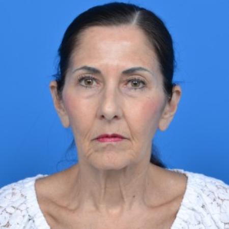 Before image 1 Case #88061 - Facelift and Neck Lift