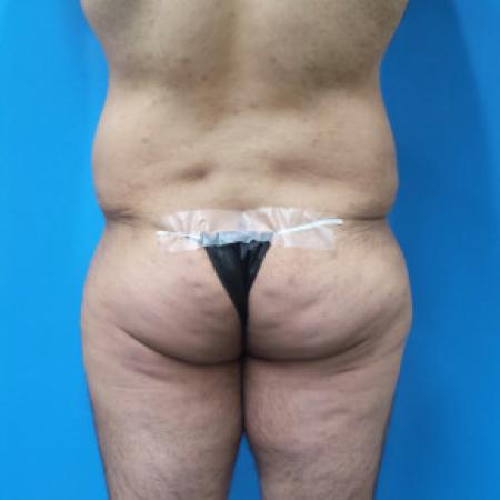 Before Case #88451 - Circumferential Body Lift /Gynecomastia Reduction