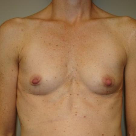 Before image 1 Case #80036 - Breast Augmentation 